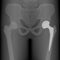 Pelvis and Hip joint problem_Total hip replacement