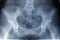 Pelvis xray