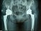 The pelvis xray with Austin Moore prothese bipolar