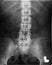 pelvis xray (x-ray)