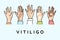 People hands with vitiligo