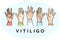 People hands with vitiligo