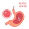 Peptic ulcer stomach disease endoscopy diagnostic infographics
