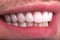 Perfect Close Up White beautiful Veneers Teeth bleaching crowns whitening young lady smiling, Male beard natural man  smile.