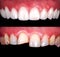 Perfect Close Up White beautiful Veneers Teeth bleaching crowns whitening young lady smiling, Male beard natural man  smile.