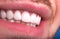 Perfect Close Up White beautiful Veneers Teeth bleaching crowns whitening young lady smiling, Male beard natural man  smile.