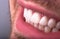 Perfect Close Up White beautiful Veneers Teeth bleaching crowns whitening young lady smiling, Male beard natural man  smile.