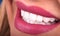 Perfect Close Up White beautiful Veneers Teeth bleaching crowns whitening young lady smiling, Sensual sexy Seductive plump Lips