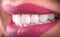 Perfect Close Up White beautiful Veneers Teeth bleaching crowns whitening young lady smiling, Sensual sexy Seductive plump Lips