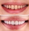 Perfect smile before and after bleaching procedure whitening of young happy smiling woman . Dental restoration treatment clinic