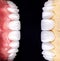 Perfect smile before and after veneers bleach of zircon arch ceramic prothesis Implants crowns. Dental restoration treatment