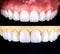 Perfect smile before and after veneers bleach of zircon arch ceramic prothesis Implants crowns. Dental restoration treatment