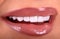 Perfect White beautiful Teeth smile ceramic crowns whitening young lady smiling. zircon implants restoration