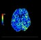 Perfusion CT scan of the brain.