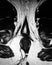 Perianal fistula abscess acute pathology mri exam