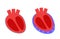Pericardial effusion heart