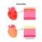 Pericarditis heart disease