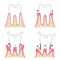 Periodontal desease