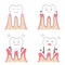 Periodontal desease