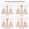 Periodontal Disease