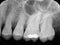 Periodontal X-ray