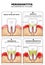 Periodontitis