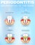 Periodontitis dental poster