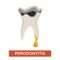 Periodontitis ill tooth dentistry mouth cavity disease