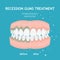 Periodontitis vector banner. Recession gums treatment. Stomatology dentistry concept