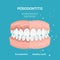 Periodontitis vector. Recession gums treatment. Stomatology dentistry concept