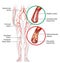 Peripheral artery occlusive disease, intermittent claudication, medical illustration