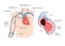 Peripherally inserted central catheter (PICC)