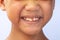 The permanent teeth in front of boys aged 8 to 10 years that are abnormal. Unusual permanent teeth are problems in eating and when