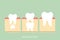 Permanent tooth located below primary tooth, anatomy structure including the bone and gum