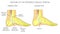 Peroneal Tendon Injuries_Rupture of the peroneus longus tendon