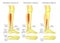 Peroneus longus muscle