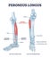 Peroneus longus muscle with leg muscular and skeletal system outline diagram