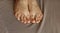 Person feet with subungual hematoma, black toenails caused by trauma, fungal infection or chemotherapy . Female