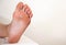 A person& x27;s foot has a large callus on its foot due to rubbing from uncomfortable shoes. Rod wart on the sole of the