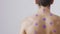 A persons back dotted with round purple marks from cupping demonstrating the use of wet cupping in Middle Eastern
