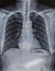 Perspective photo of human chest, medical impact examination