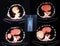 Pet/ct level of mediastinum