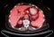 Pet/ct liver intestine nuclear medicine