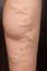 Phlebeurysm, varicose veins of the lower extremities close-up, peripheral vascular disease