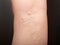 Phlebeurysm, varicose veins of the lower extremities close-up, peripheral vascular disease