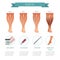 Phlebology infographic, treating varicose veins. Vector illustration of stage of vein diseases. Medical compression