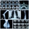 Photo collage: Radiography of Human Bones