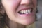 Photo of crooked woman teeth