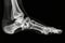 This photo depicts an x-ray image of a foot with a clearly visible broken bone, Ankle and foot in a single X-ray projection, AI