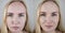 Photos before and after mesotherapy, biorevitalization, botulinum toxin injections. Skin fold between eyebrows, forehead wrinkles